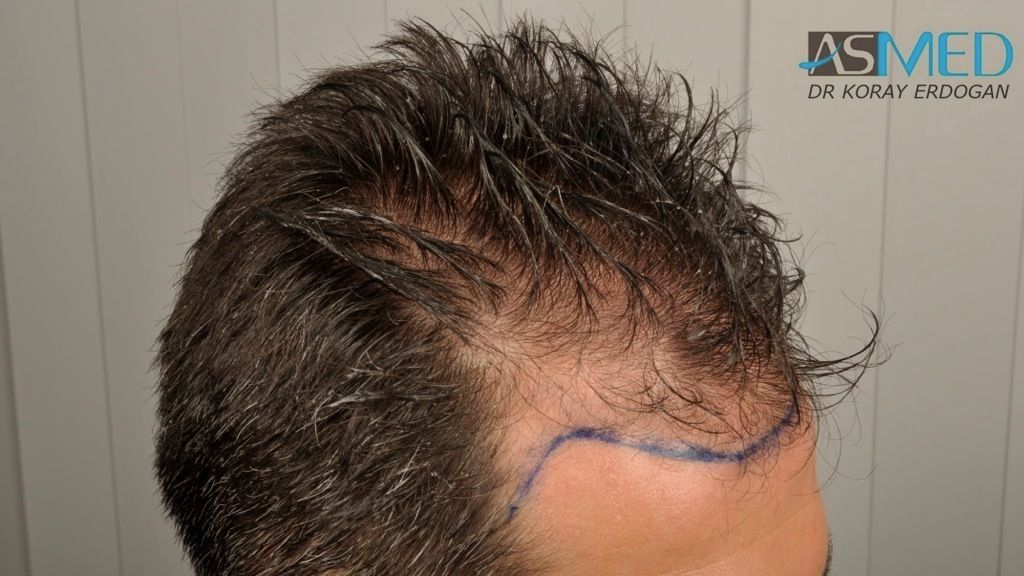 Mezzi per chiarificazione di posizione di capelli